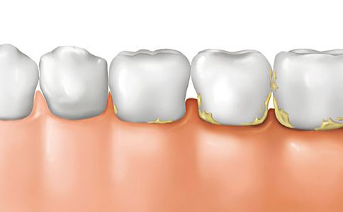 在廊坊，牙结石有多可怕？