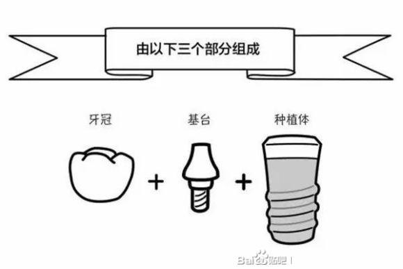 廊坊的种植牙组成部分你了解吗