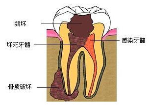 廊坊人牙齿烂了一半为什么不能直接补？