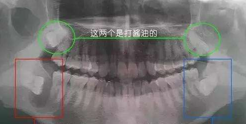 在廊坊，为什么拔智齿还要拍片？