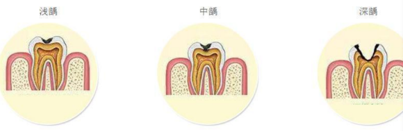 在廊坊，牙齿有洞，一定要做根管治疗吗？