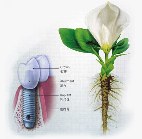 廊坊人的种植牙有年龄限制吗？