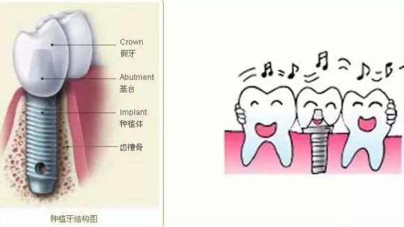 廊坊牙齿种植过程是什么