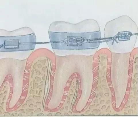 牙齿矫正原理，一根弓丝的力量有多强大？！