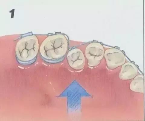 牙齿矫正原理，一根弓丝的力量有多强大？！