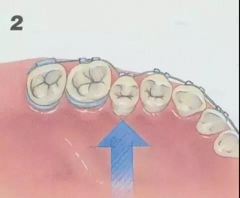 牙齿矫正原理，一根弓丝的力量有多强大？！