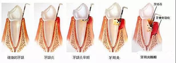 洗牙和牙周刮治区别在哪里？