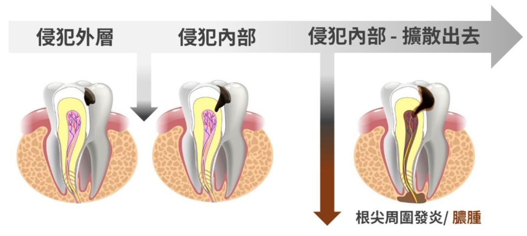 还在喊牙疼？这 7 种原因都需要及时治疗！