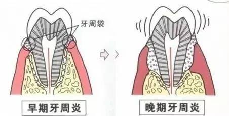 牙周炎六大症状，你中了几招？