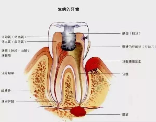 牙疼为什么要抽掉牙神经？