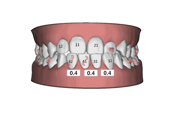 今日高考，改变人生的不只高考，还有牙齿矫正