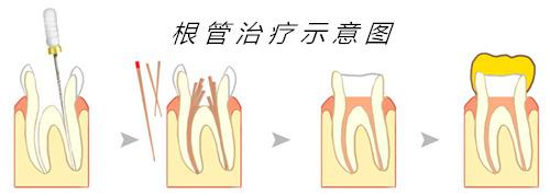 扎心！这是不是蛀牙患者最怕的事...