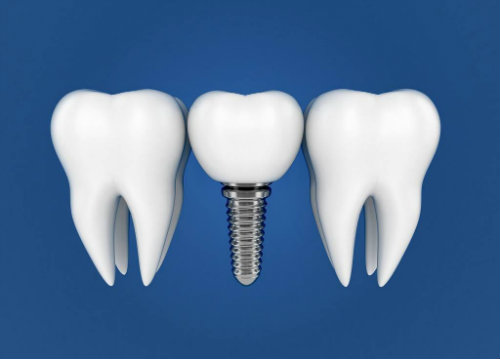 种植牙要想用一生，这些“功课”你做了吗？