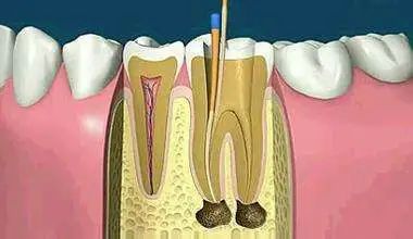 干货 | 别再说根管治疗就是“杀神经”了，快来了解一下它！