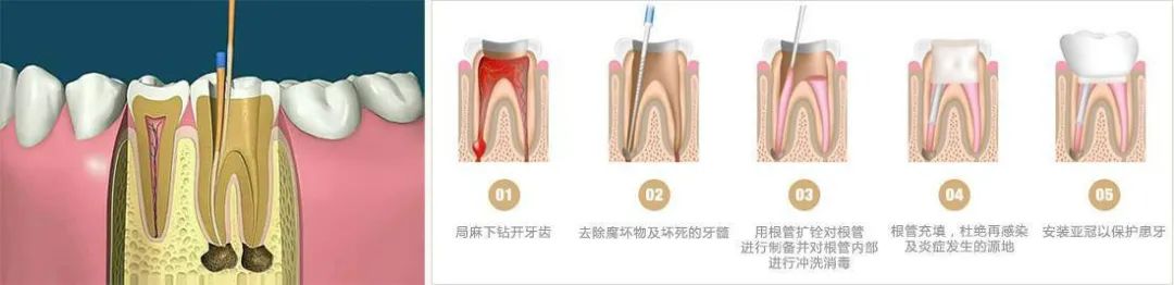 干货 | 别再说根管治疗就是“杀神经”了，快来了解一下它！