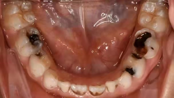 要像爱护钻石一样保护自己的牙齿！