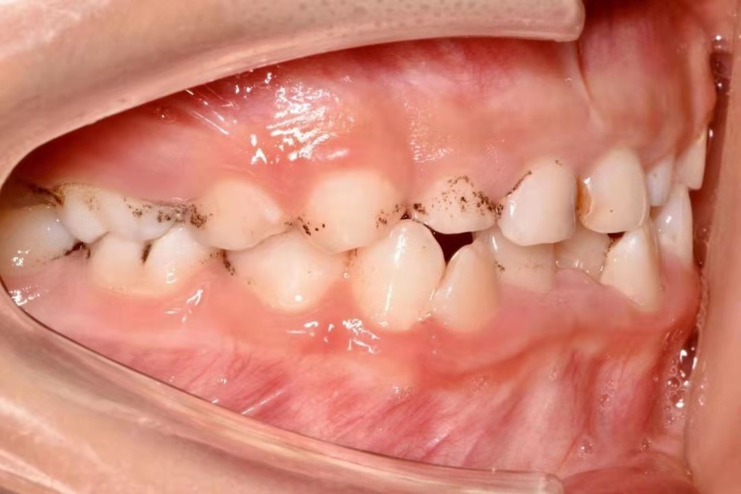孩子牙齿上的黑色素是什么？能去掉吗？