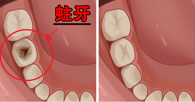 为什么孩子的蛀牙都是后牙？
