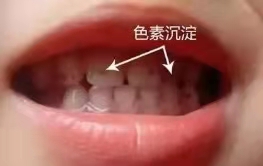 孩子牙齿上的黑色素是什么？能去掉吗？