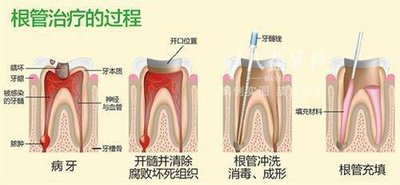 为什么牙齿表面只有一个小洞，却严重到需要根管治疗？