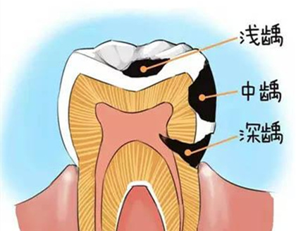 为什么牙齿表面只有一个小洞，却严重到需要根管治疗？