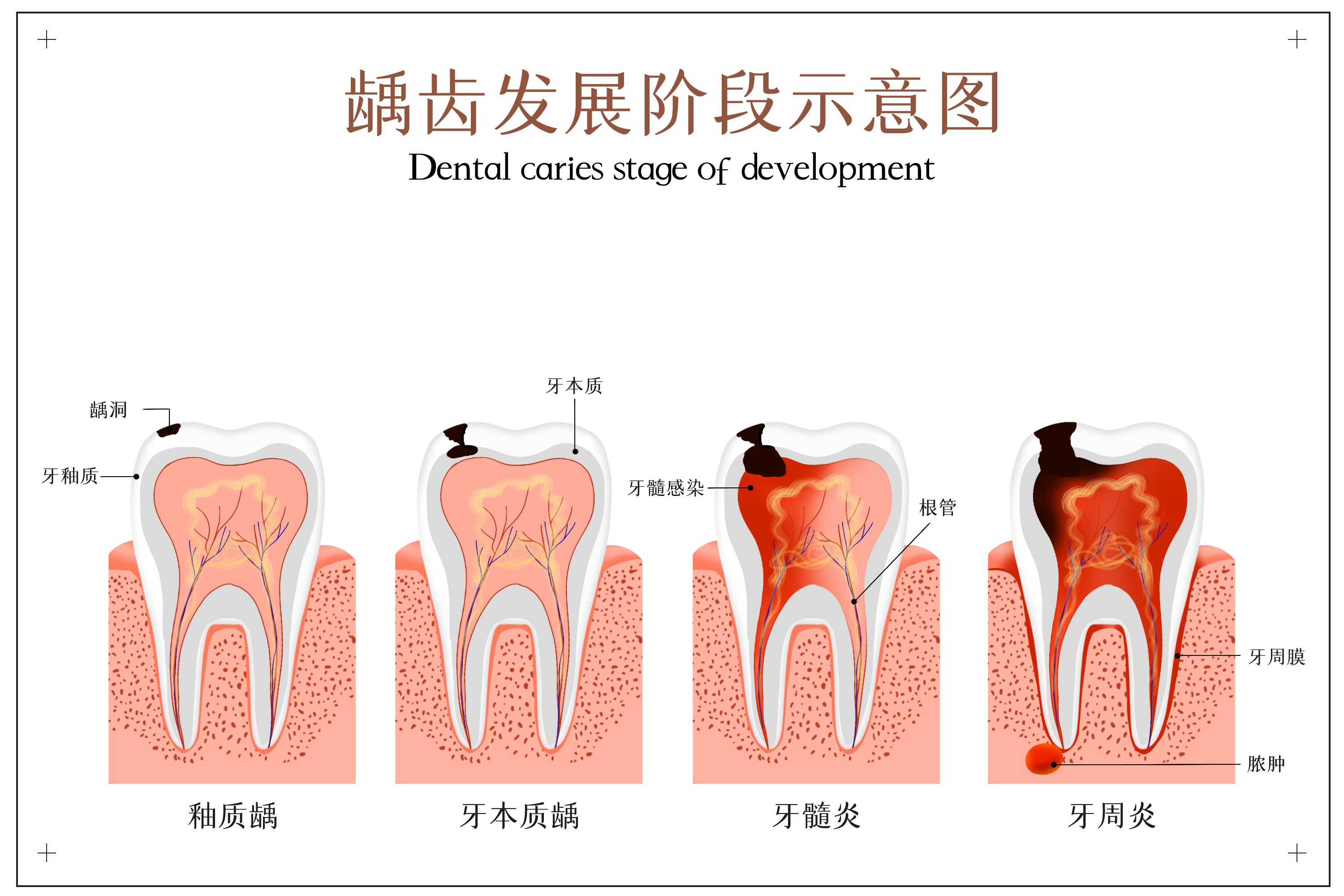 摄图网_401803641_龋齿发展阶段示意图(非企业商用).jpg