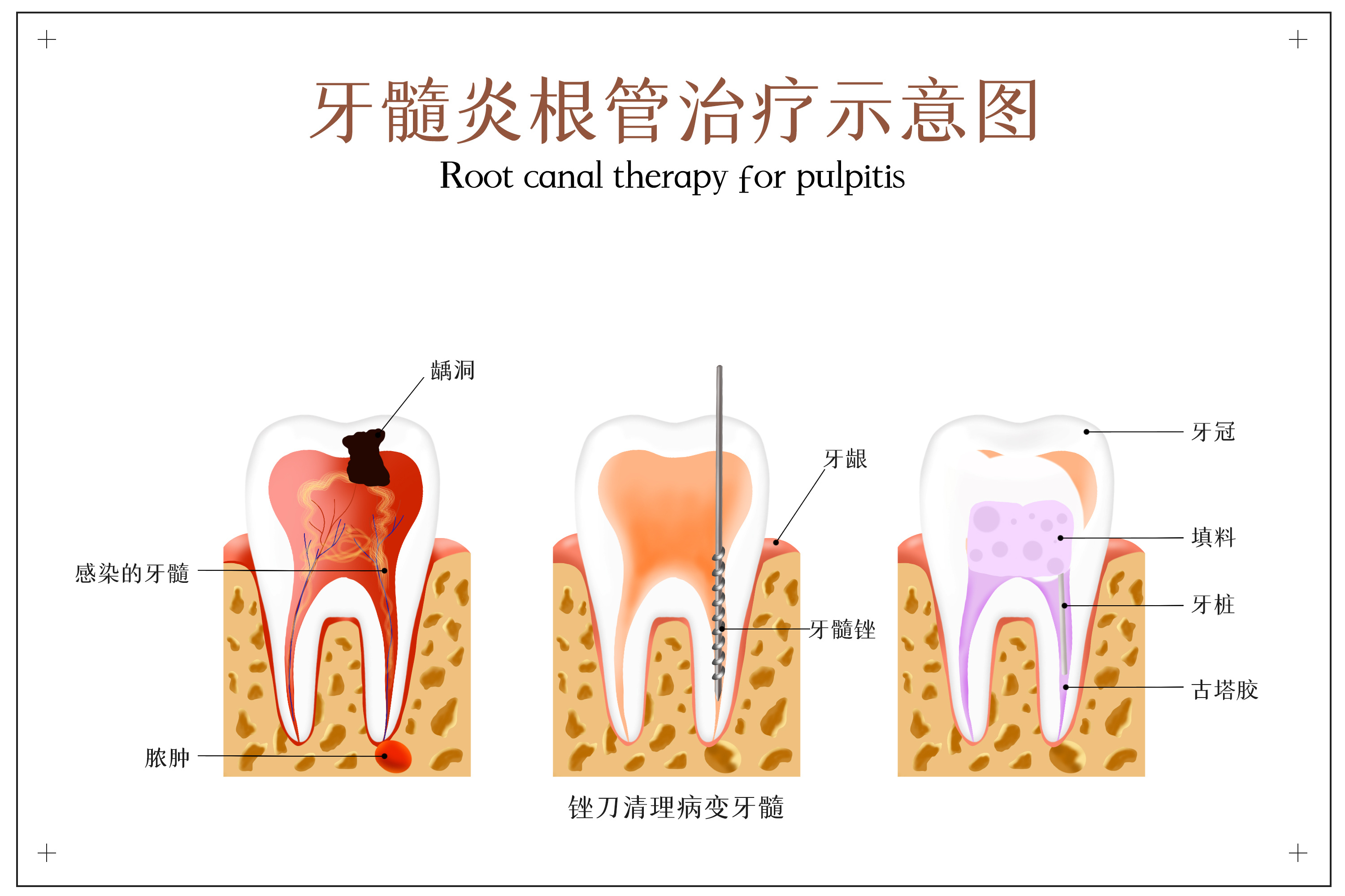 摄图网_401803635_牙髓炎根管治疗示意图(非企业商用).jpg