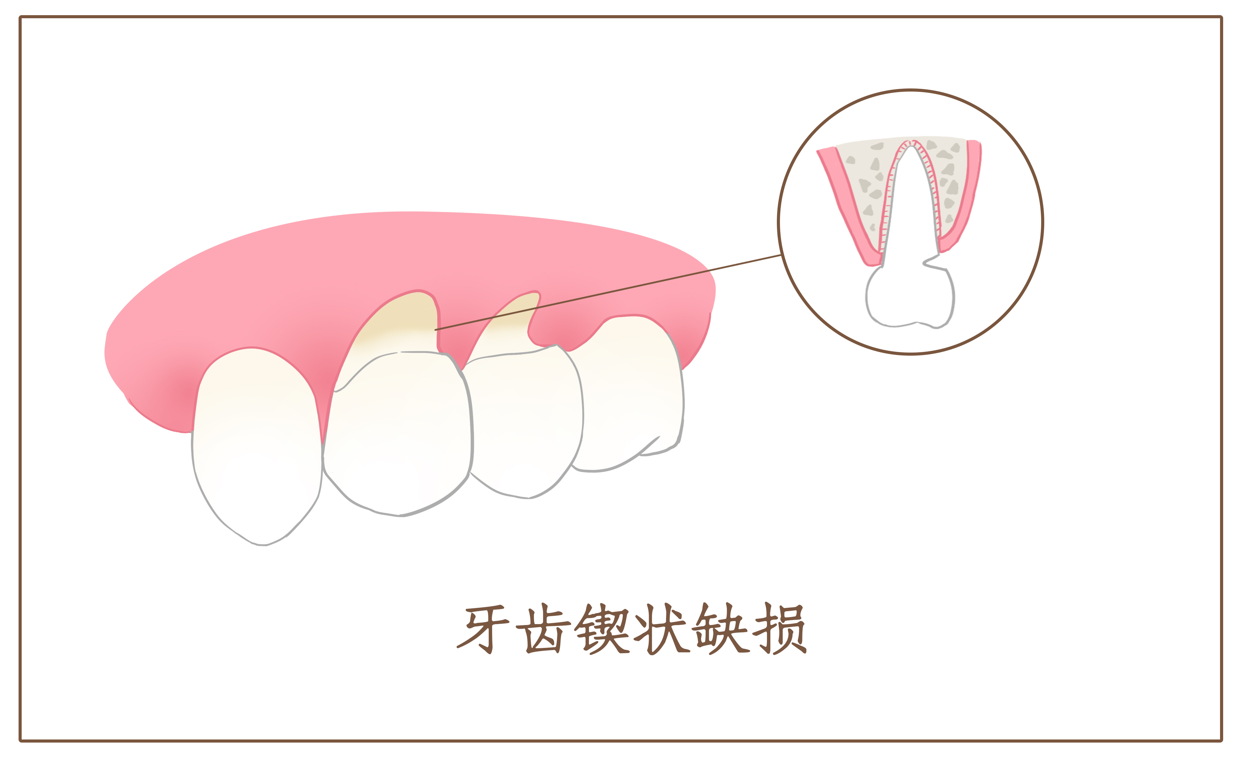 摄图网_401806646_牙齿锲状缺损口腔医学配图(非企业商用).jpg