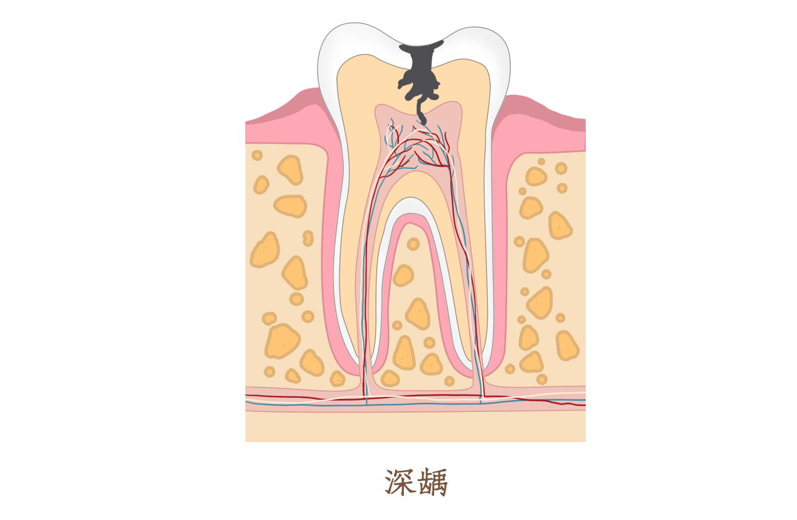 摄图网_401808342_龋齿发展过程口腔医学配图(非企业商用)(1).png