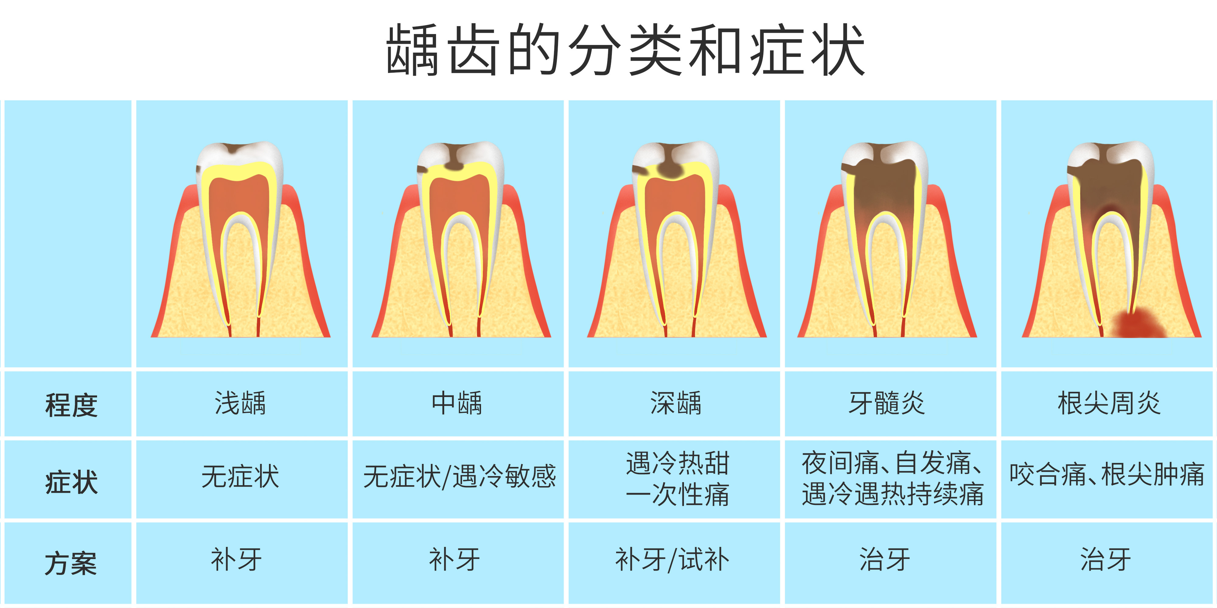 摄图网_401804268_龋齿的分类和症状科普医疗插画(非企业商用).jpg