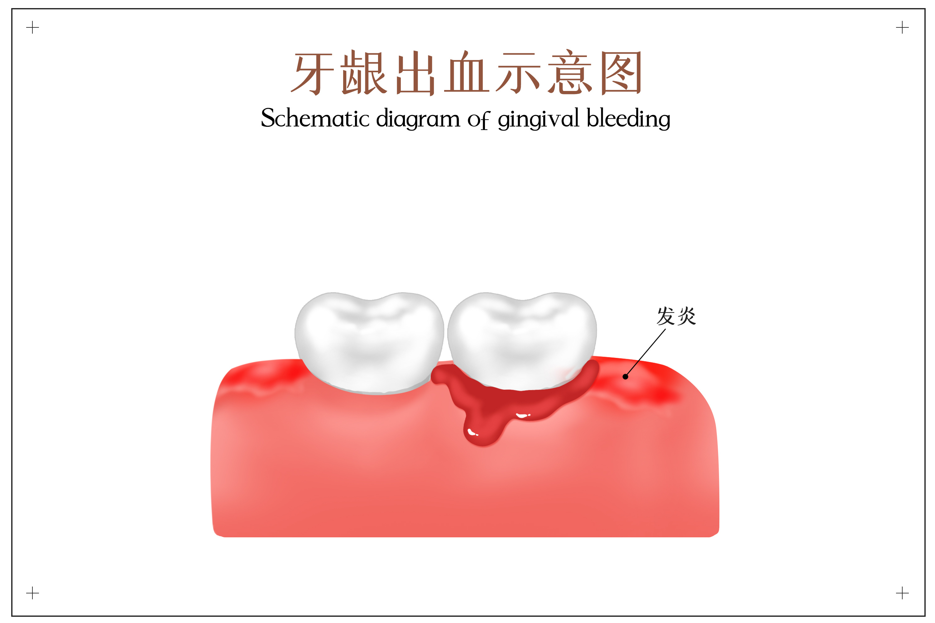 摄图网_401859954_牙龈出血示意图(非企业商用).jpg